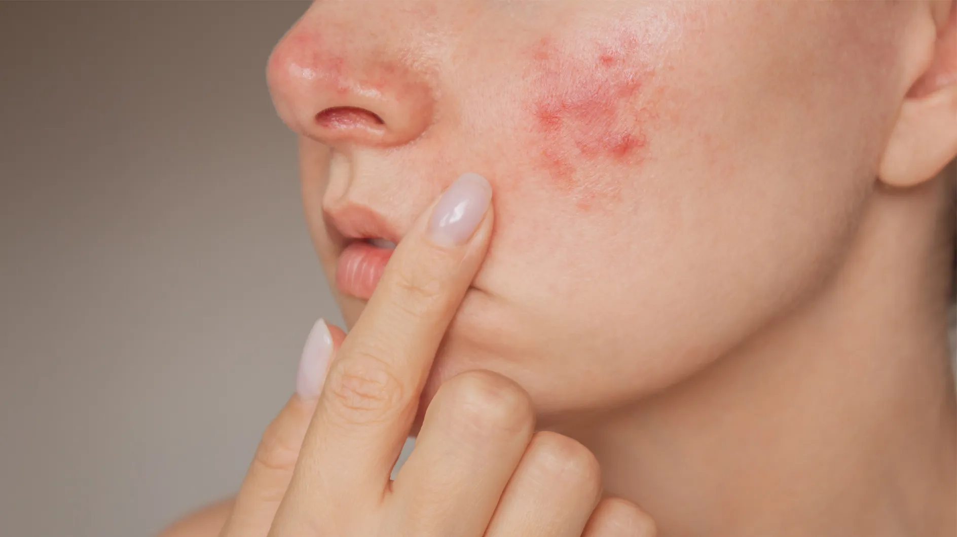 Joues rouges : Cette crème apaise immédiatement les peaux irritées en hiver